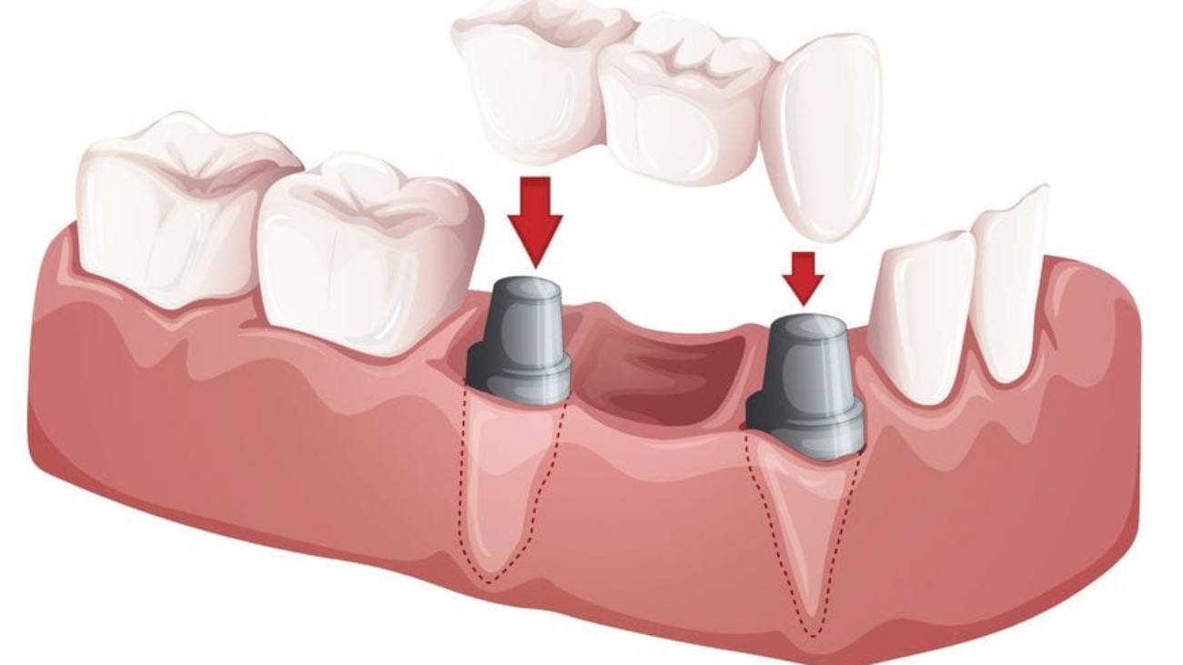 illustration of a dental bridge