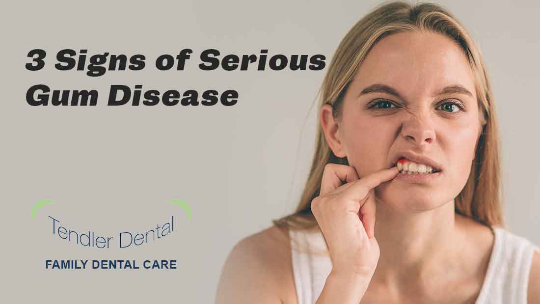 3 Signs of Serious Gum Disease