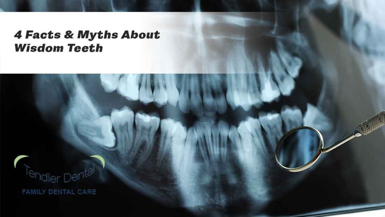 4 Facts & Myths About Wisdom Teeth