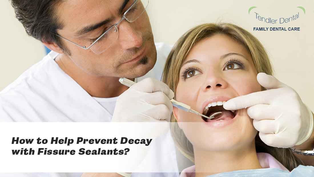 How to Help Prevent Decay with Fissure Sealants