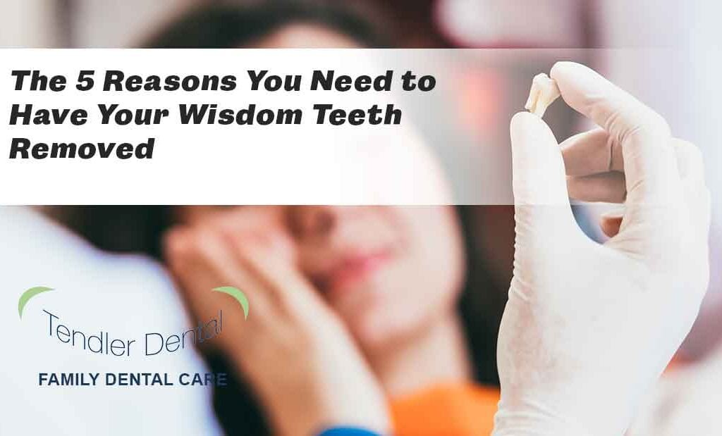 The 5 Reasons You Need to Have Your Wisdom Teeth Removed