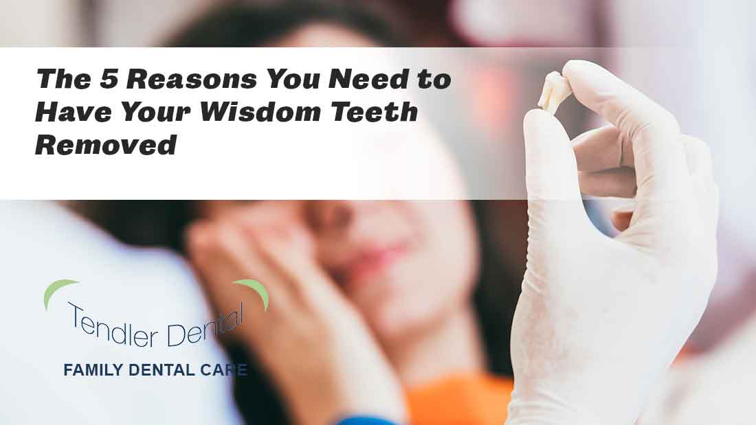 The 5 Reasons You Need to Have Your Wisdom Teeth Removed