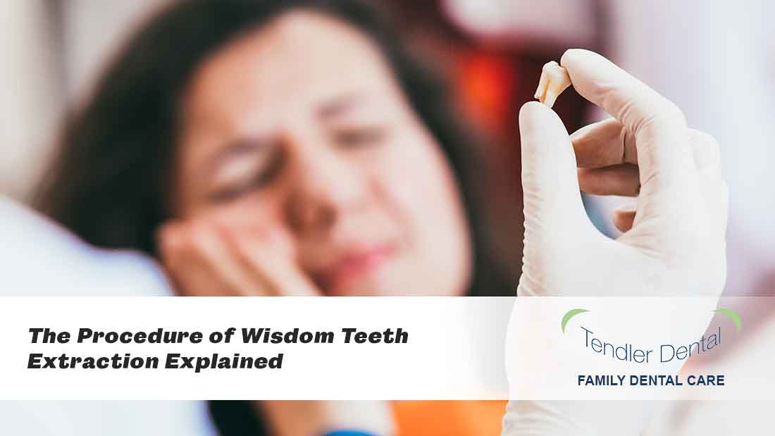 The-Procedure-of-Wisdom-Teeth-Extraction-Explained