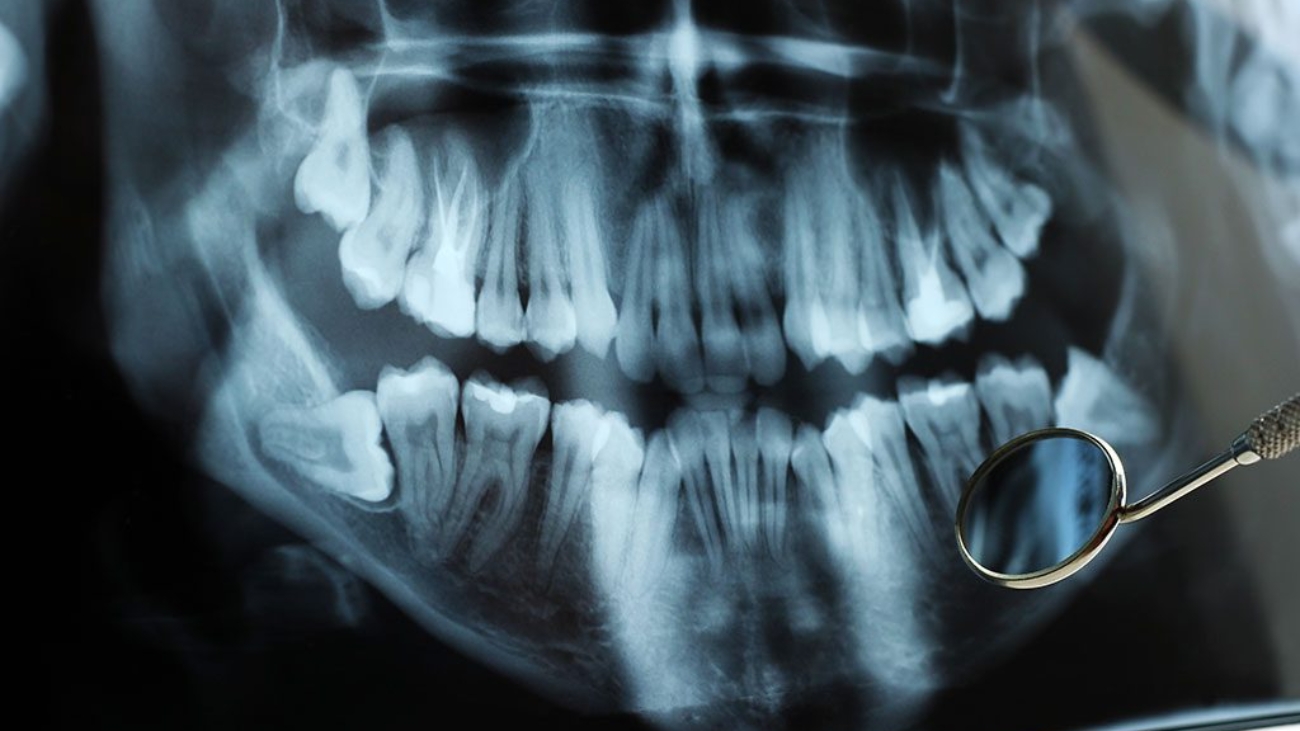 Impacted Wisdom Teeth Hawthorn