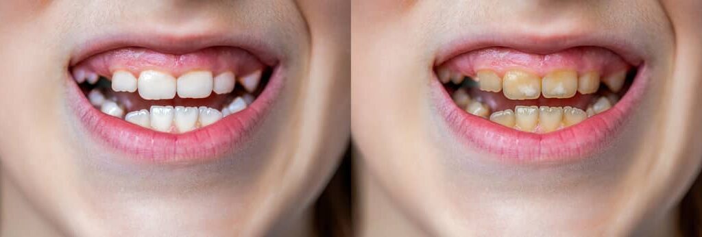 stained teeth treatment hawthorn