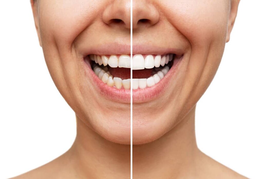 dental veneers hawthorn