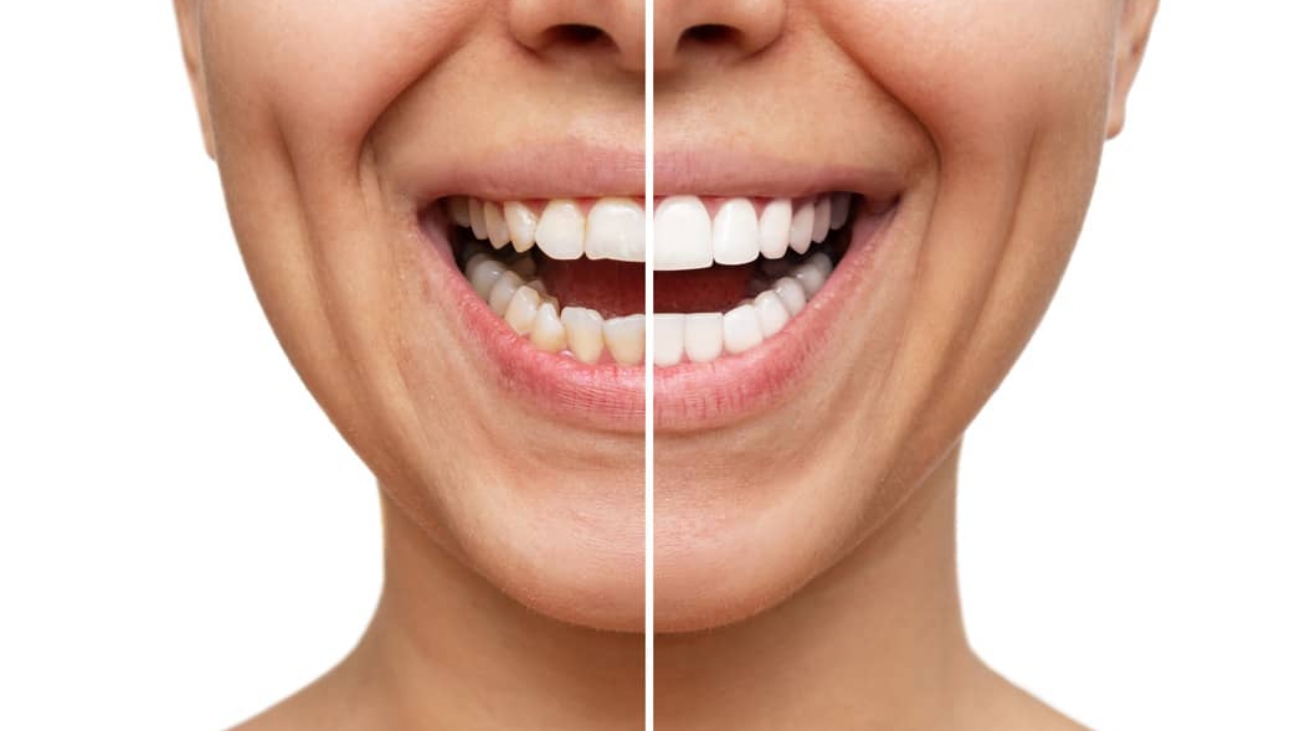 dental veneers hawthorn