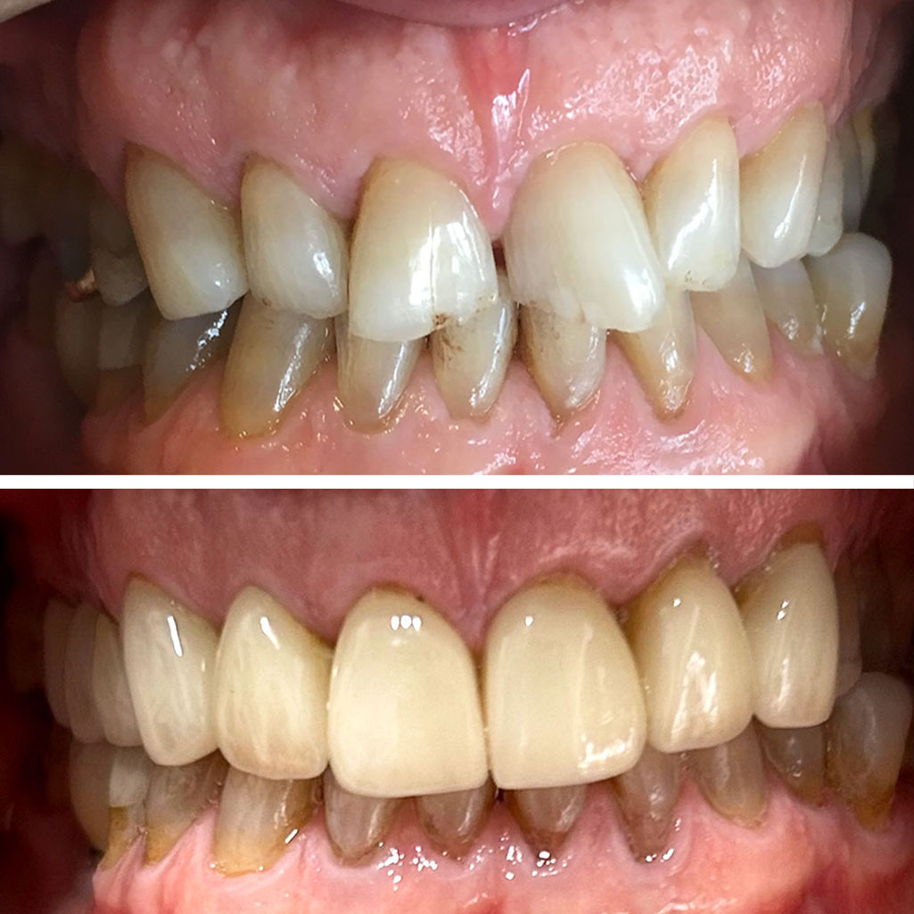 porcelain veneers
