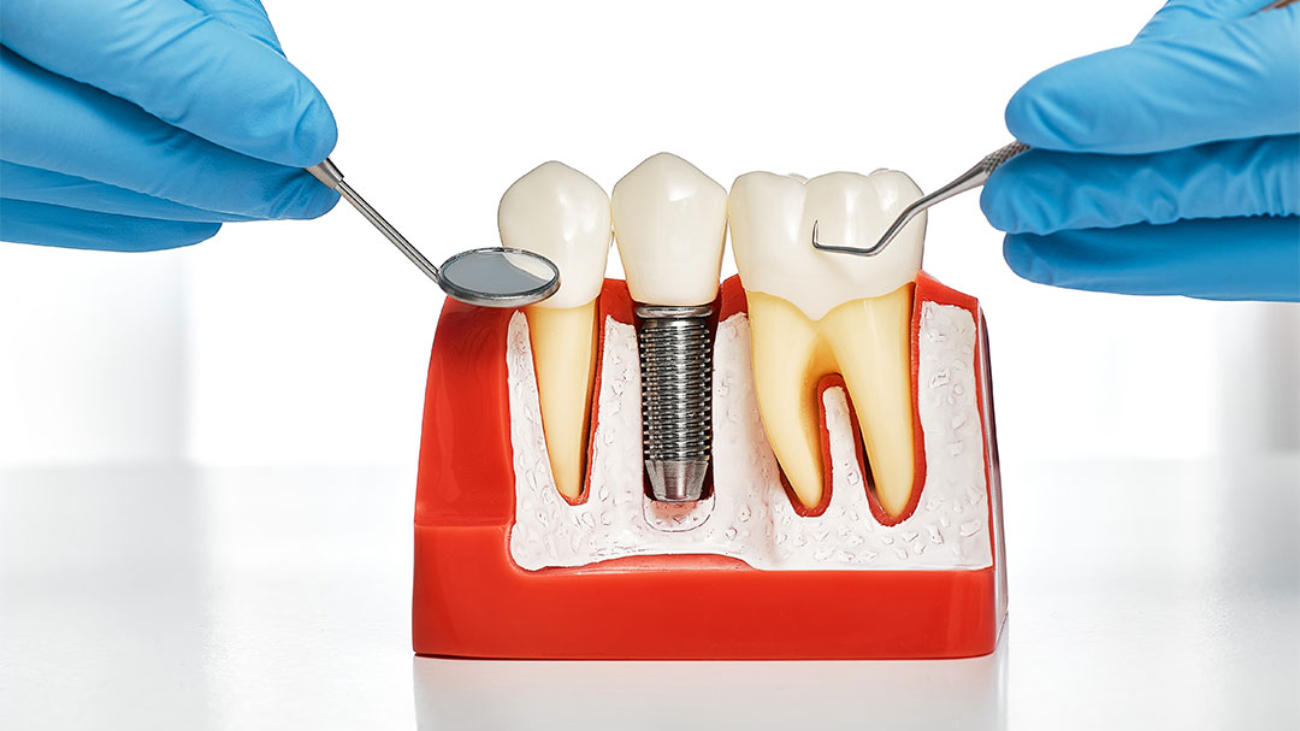dental-implants-blog