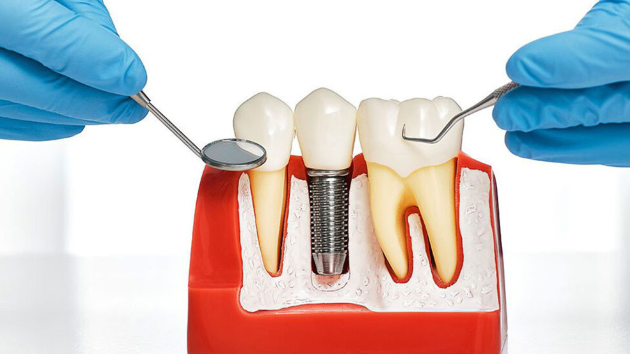 dental-restoration-blog-image