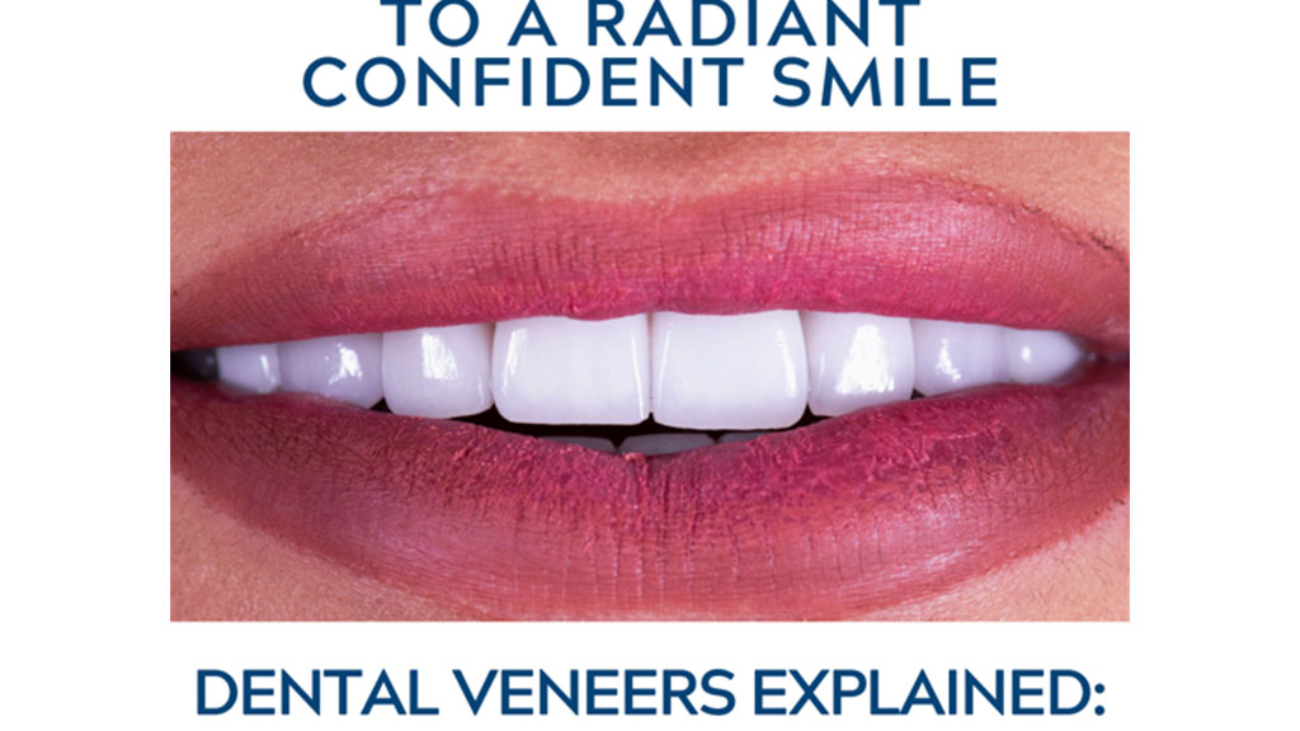 Dental-Veneers-Image