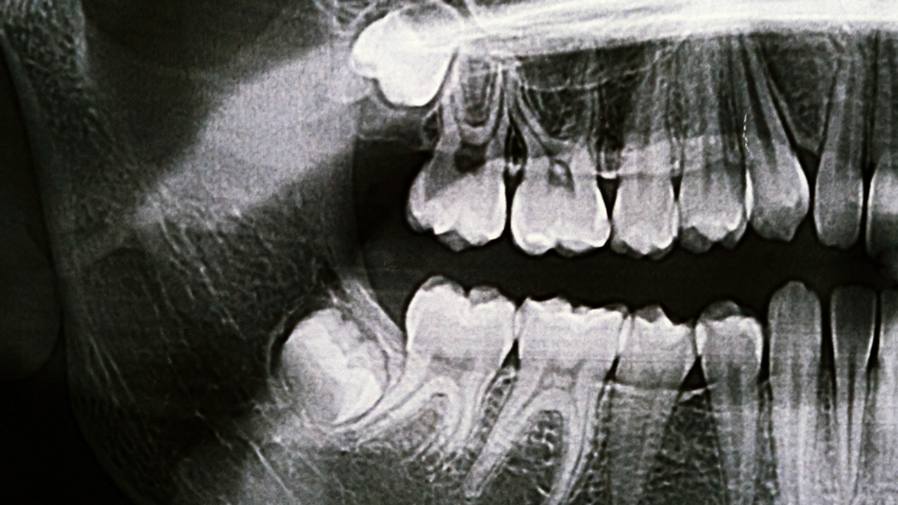 wisdom-teeth-image